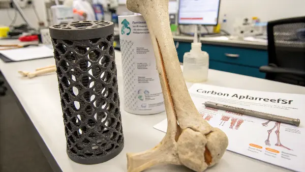 An illustration showing a carbon fiber spinal implant in place